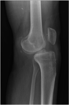 Knee Dislocation Posterior Subluxation